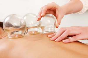 cupping treatment with cups placed on clients back